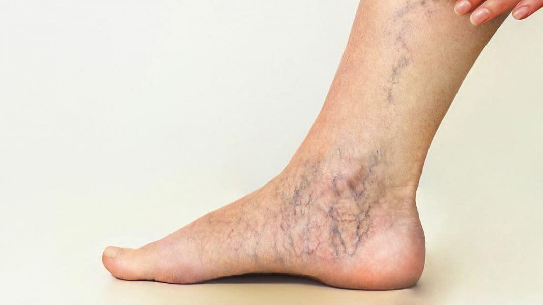 نتائجها سريعة .. وصفة طبيعية لعلاج الدوالى