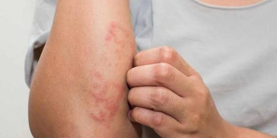 بشرتك في خطر مع حرارة الصيف .. أمراض جلدية شائعة وطرق الوقاية منها - لايف نيوز