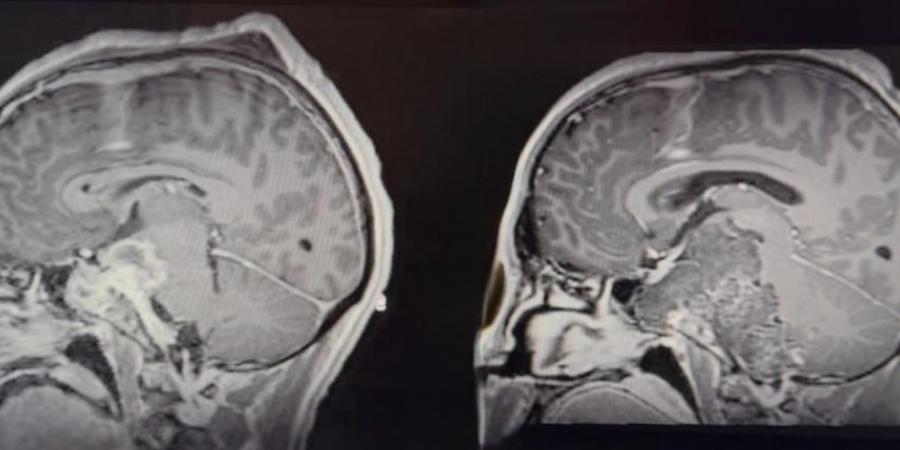 جدة.. استئصال ورم حبلي نادر من قاع جمجمة مريض خلال 35 ساعة - لايف نيوز